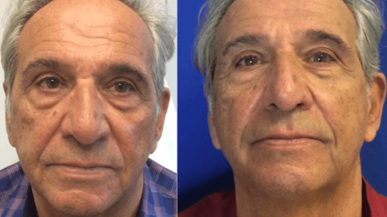 Dr SUzman male facelift and fa